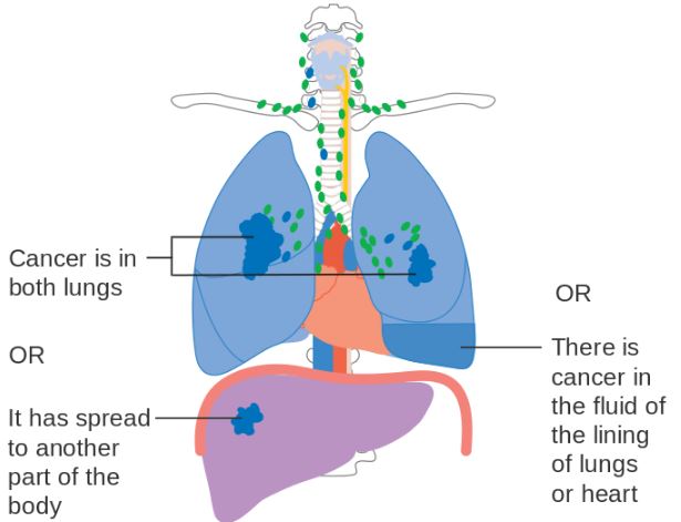 lung_cancer_stage_iv_keytruda