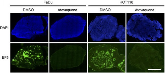 atovaquone malaria cancer hypoxia radiotherapy