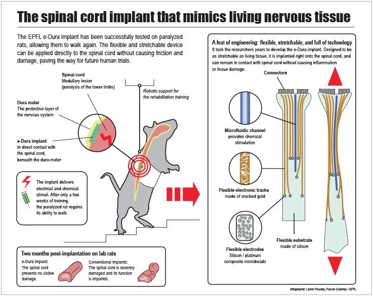 edura_spinal_injury_medtech_epfl