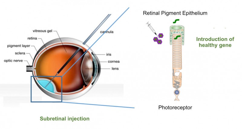 eye gene therapy retinitis pigmentosa horama