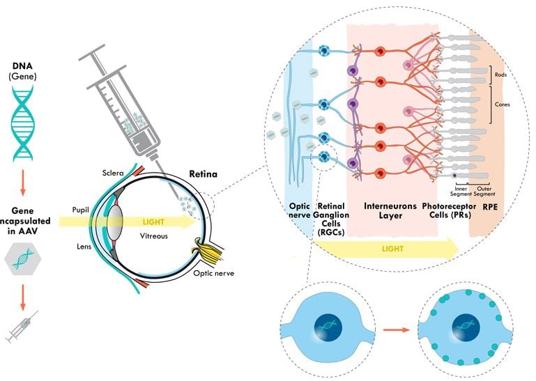 gensight gene therapy blindness ophtalmology