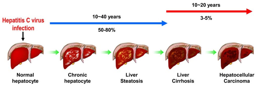 hepatitis c hcv liver disease cirrhosis cancer