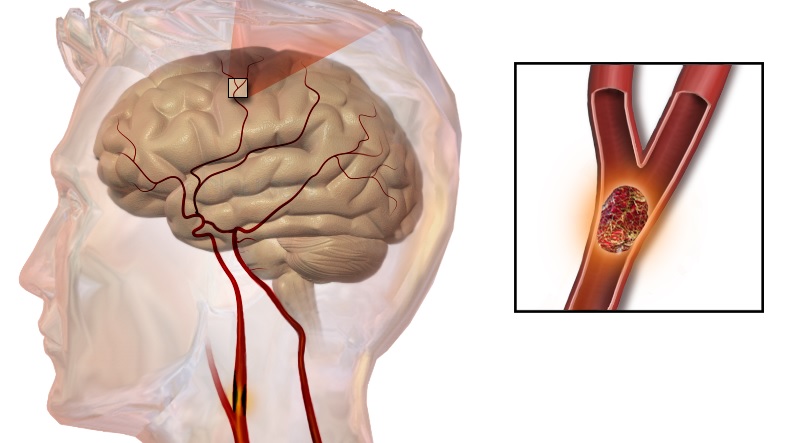 ischemic stroke boehringer ingelheim cardiovascular