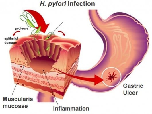 RedHill's main focus is gastrointestinal diseases, having different clinical programs with antibiotics to tackle its causes. (Source: RedHill Biopharma)