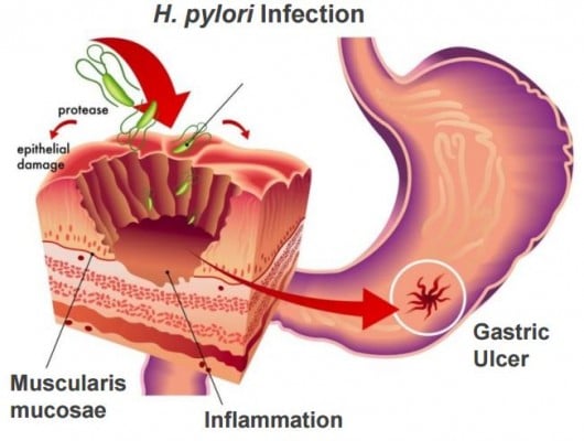 RedHill's main focus is gastrointestinal diseases, having different clinical programs with antibiotics to tackle its causes. (Source: RedHill Biopharma) 