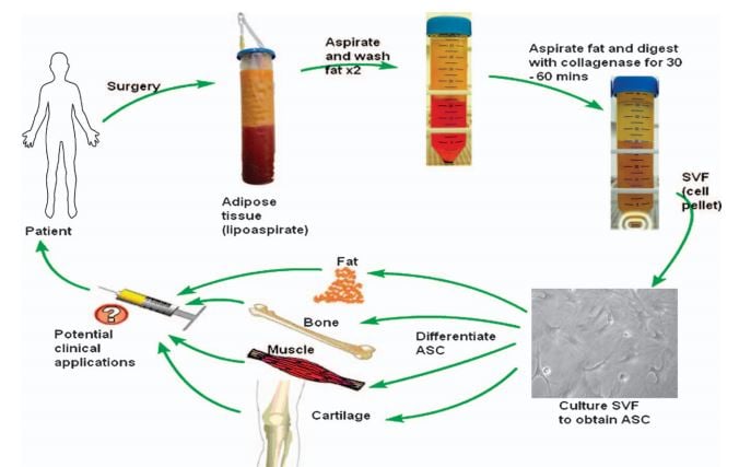 tigenix crohns adipose derived stem cells easc