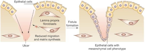 tigenix crohns perianal fistulas physiology