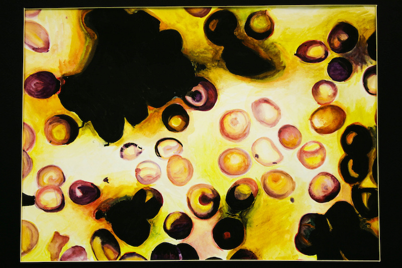 Figure 1. A watercolour of red blood cells in plasma. Multiple Myeloma starts in the bone marrow and then proliferates to plasma cells.