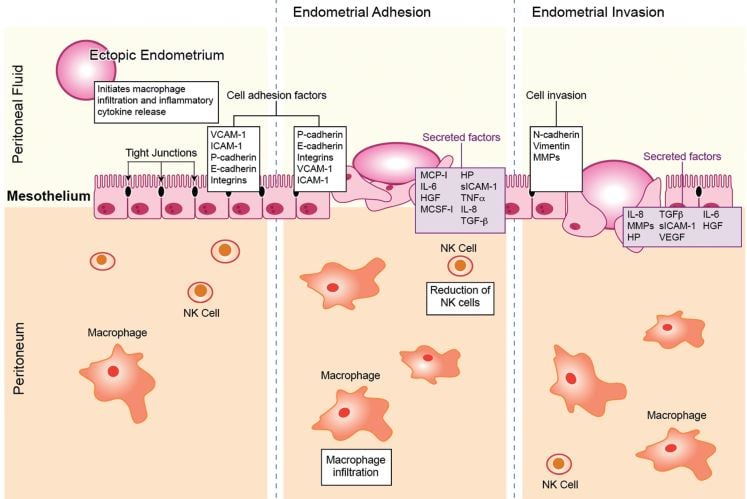 endometriosis mechanism adhesion invasion physiology