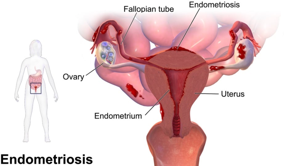 endometriosis therapies physiology woman health