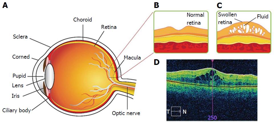 physiology diabetic macular edema eye-drops