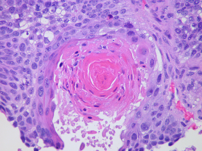 Figure 1. Squamous cell carcinomas could be treated with these new therapies.