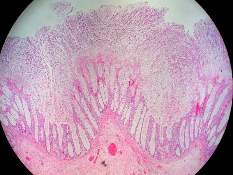 Figure 1. Colitis is inflammation of the colon, which is generally caused by an infection by C. difficile.