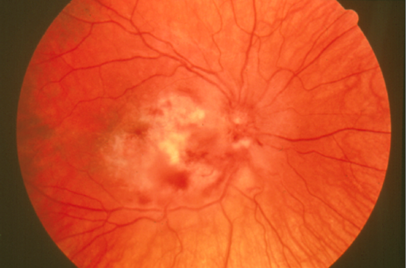 Figure 1. CMV retinitis, the (non-hereditary) inflammation of the retina, can also lead to blindness.