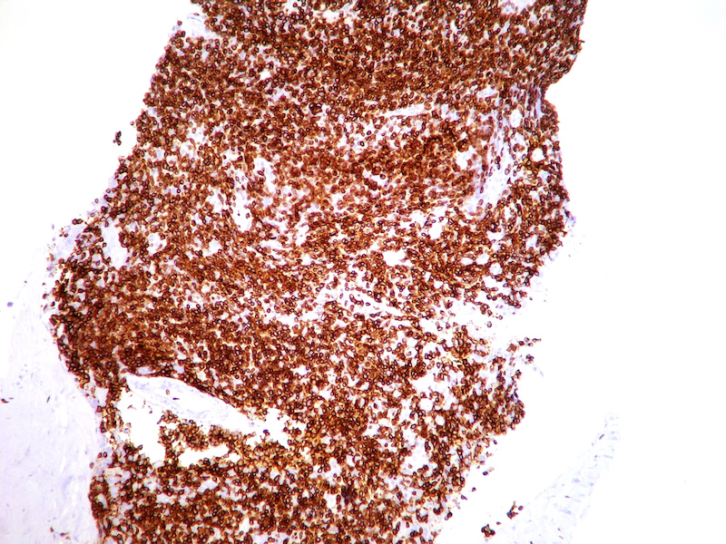 Figure 1. Lymphocyte gets lit: CD3 is a T-cell marker that stains red.