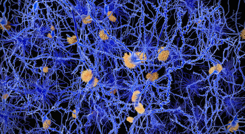 Figure 1. Amyloid beta plaques are one of the hallmarks of Alzheimer's Disease.