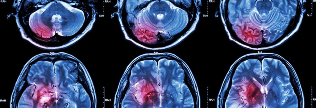 brain tumor Puwadol Jaturawutthichai FI