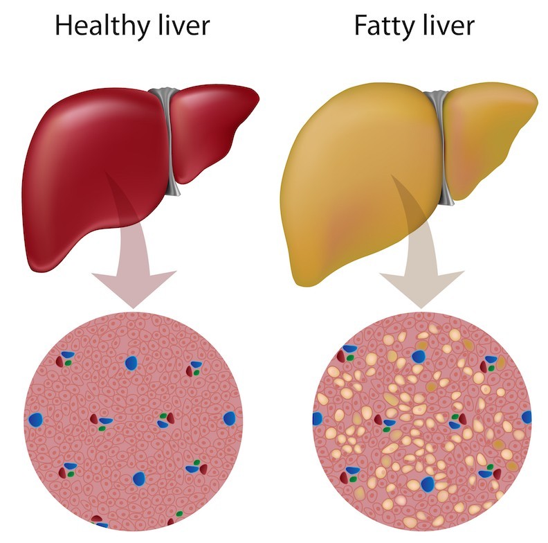 Figure 1. NASH consists in the accumulation of fat, inflammation and degeneration of the liver. It highly increases the risk of cirrhosis and <a class=