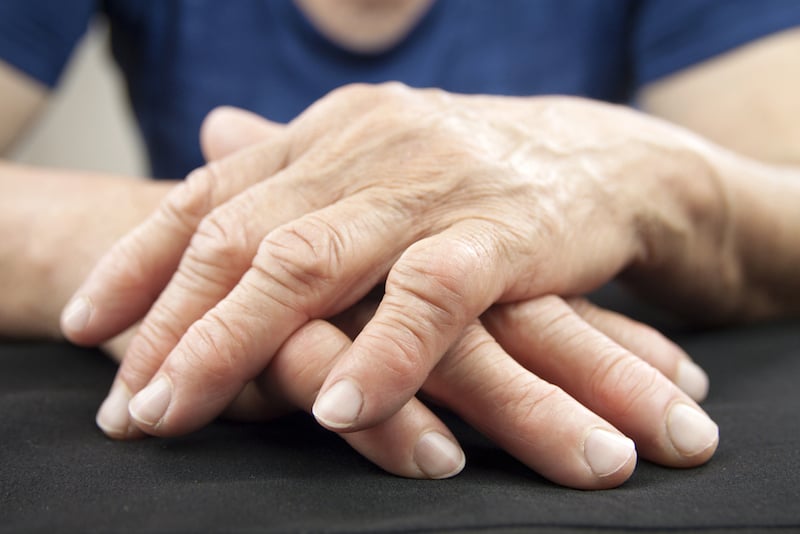 Figure 1. Hands are a common site for arthritis.