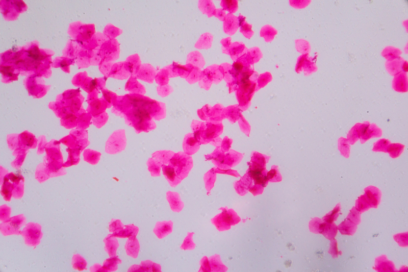 Figure 1. Tumor cells under a microscope