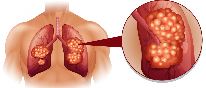 Achilles Therapeutics targets Lung Cancer