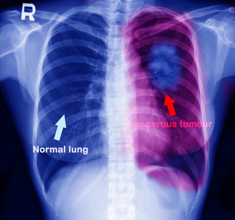 lung-cancer-tumor-wonderisland-small