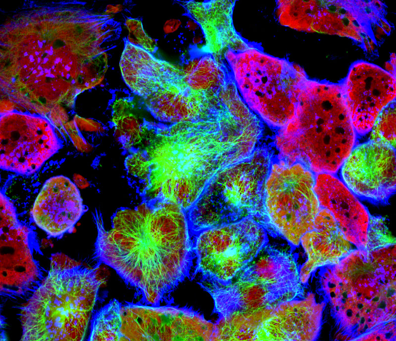 Figure 2. Tumor cells 