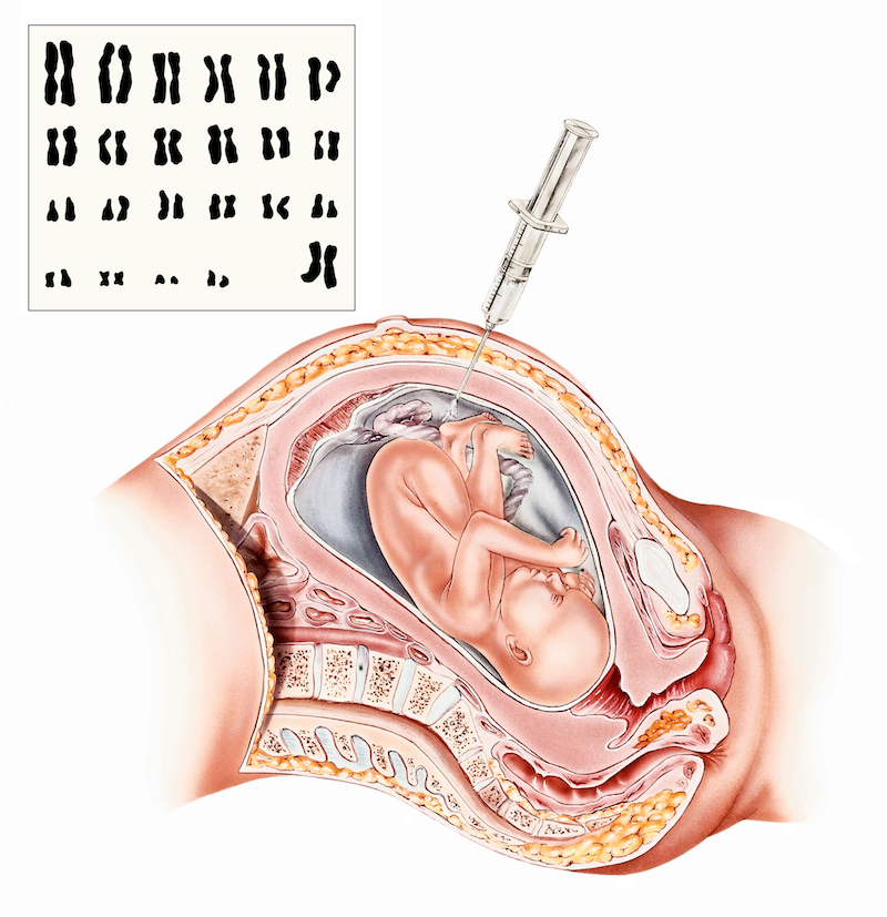 prenatal-test-amniocentesis-medical-art-inc-small