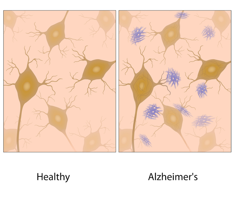 A hallmark of Alzheimer's is the development of amyloid beta plaques. In contrast with current approaches to clear these plaques, those in the anti-aging space strive to stop them from forming at all.