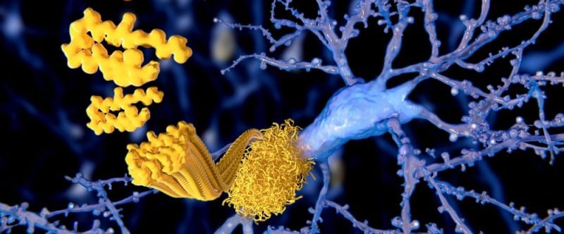 amyloid beta plaques Alzheimer's