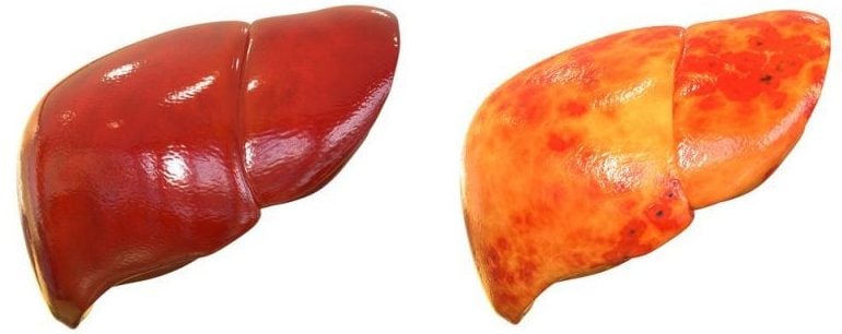 NASH consists in the accumulation of fat, inflammation and degeneration of the liver. It highly increases the risk of cirrhosis and cancer.