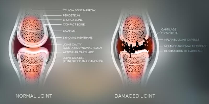 Arthrogen rheumatoid arthritis joint gene therapy