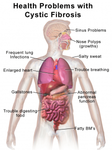 Blausen_0286_CysticFibrosis (1)