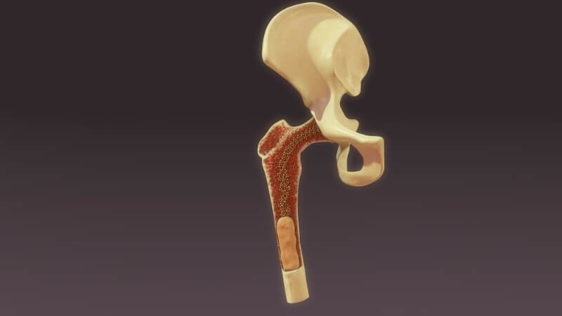 Imperial College London Multiple Sclerosis bone marrow