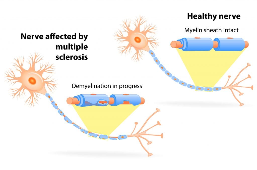 MS nerves