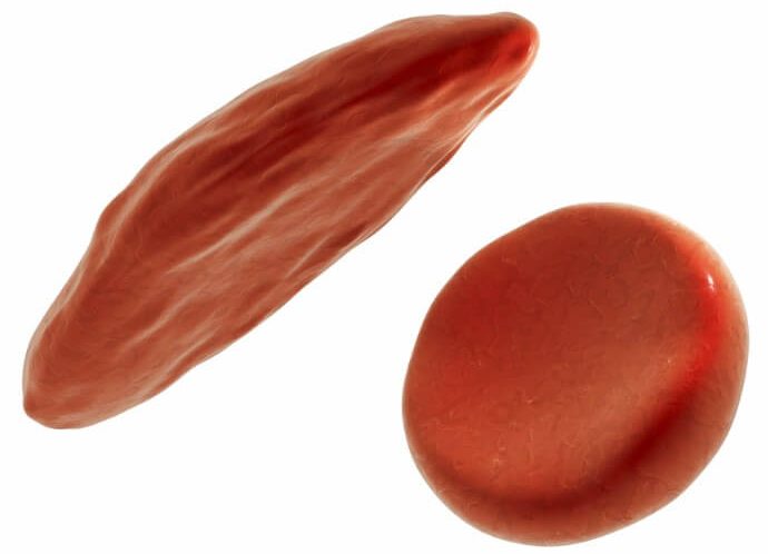 Modus Therapeutics Sickle Cell DIsease Blood
