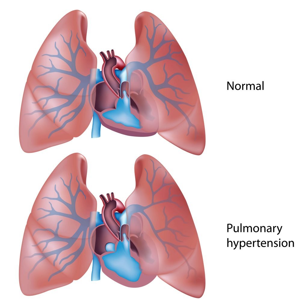 Pulmonary Hypertension