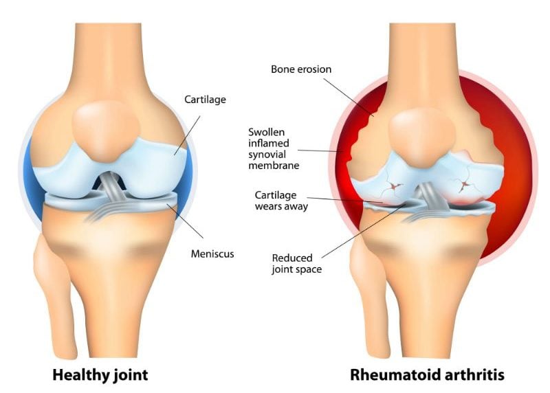 Rheumatoid Arthritis_Joints