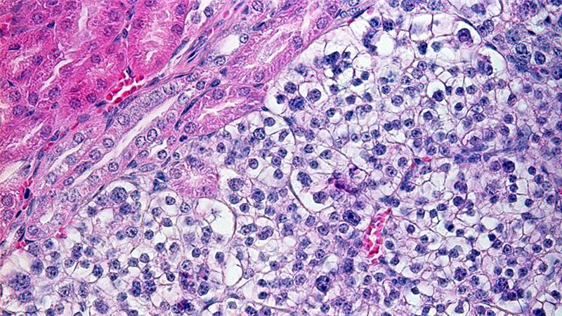 Kidney-cancer-histology