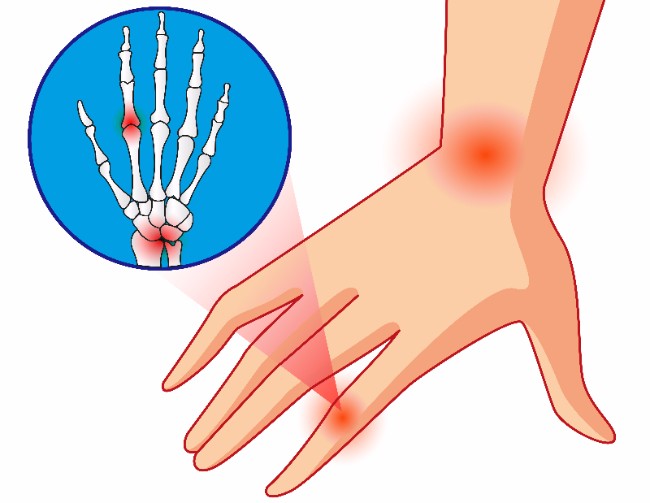 Merck Ablynx milestone nanobody osteoarthritis