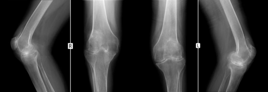 Merck Ablynx nanobody osteoarthritis