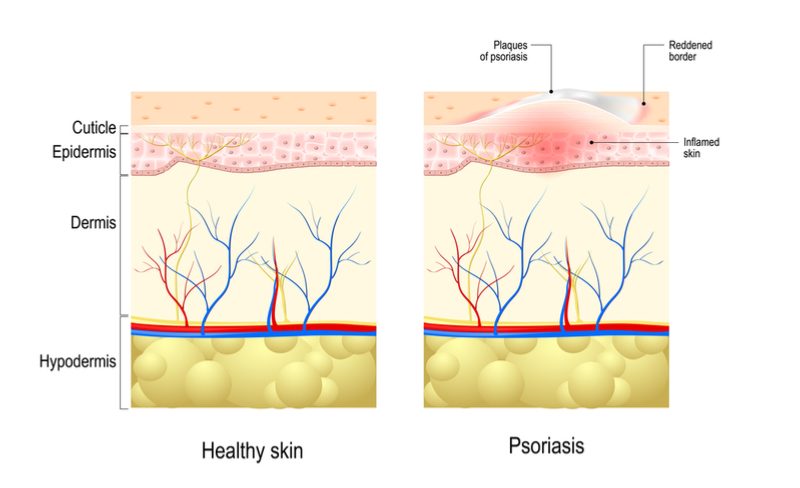 Psoriasis-brodalumab