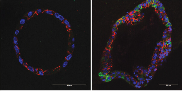 In organoid cultures, mouse residual breast cancer cells (right) have elevated lipid metabolism (green)