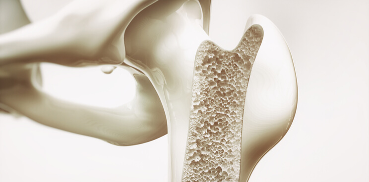 Bonesupport IPO biomaterial bone repair