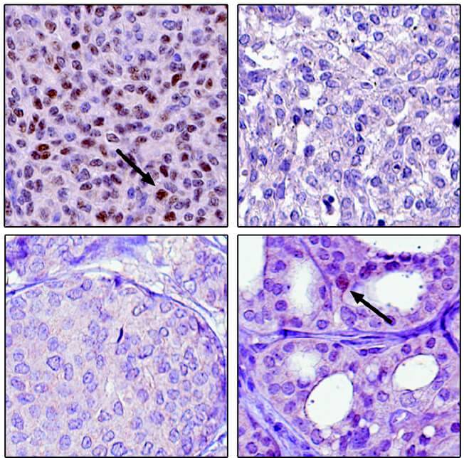 KTH-Breast-Cancer
