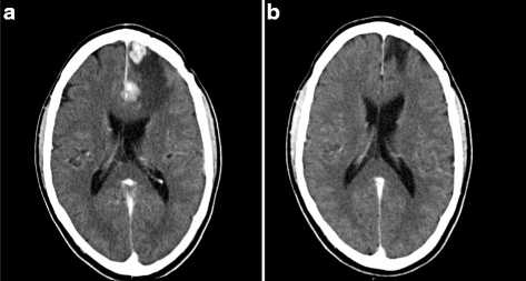 immunicum kidney cancer ilixadencel intuvax