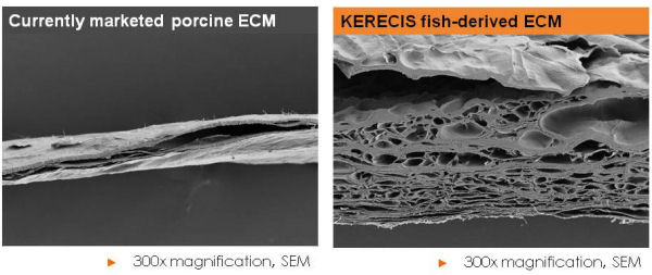 kerecis fish skin wound dressing