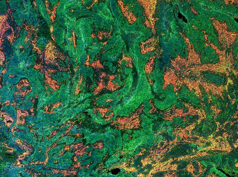 A tumour sample where the levels of different proteins in cell populations have been identified using a fluorescently labelled antibody