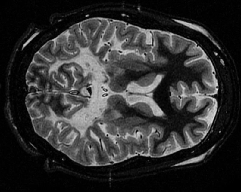 MRI scan of the brain of a patient with X-ALD