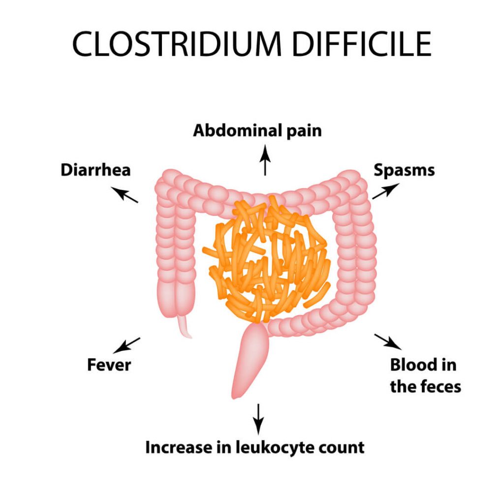 Precision Antibiotic Improves Outcome of Gut Infections in Phase II